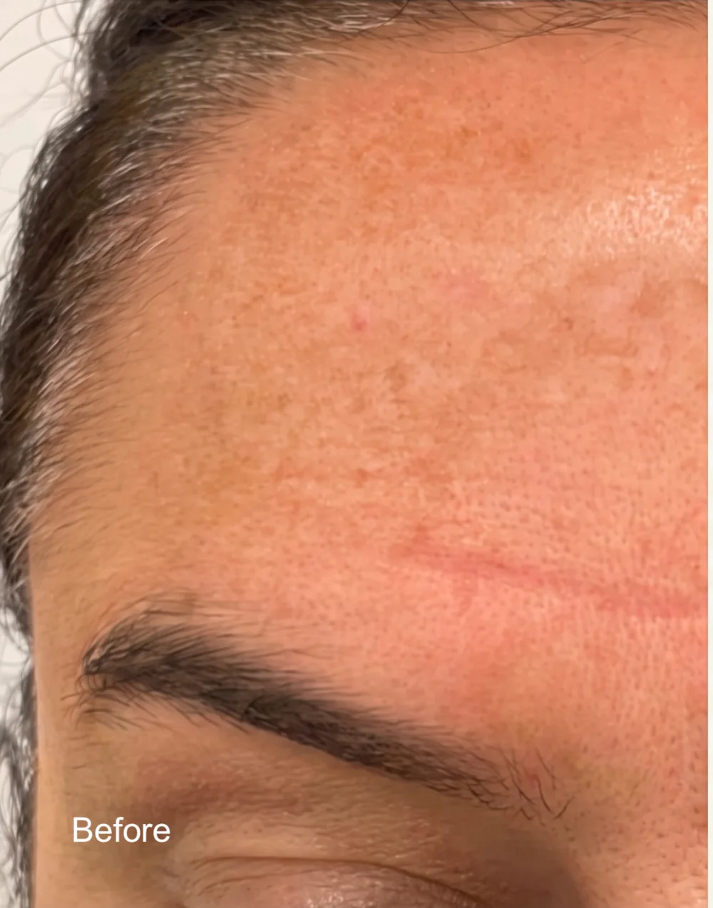 Visible pigmentation before treatment