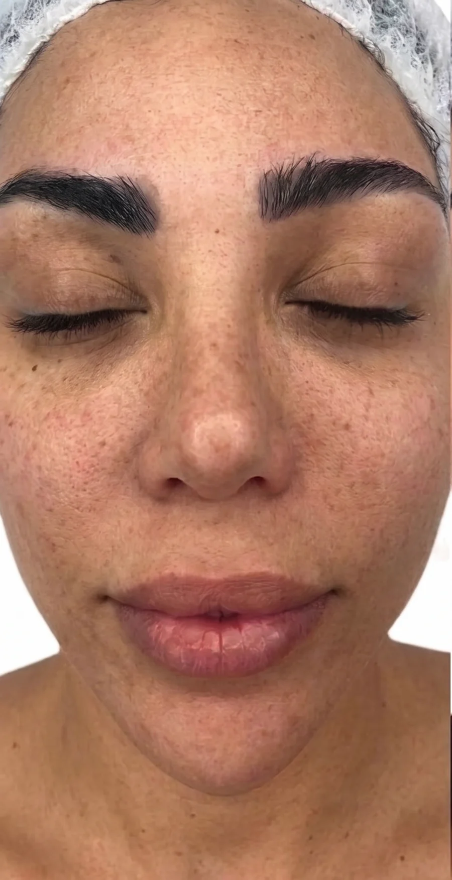 Visible sun damage before treatment