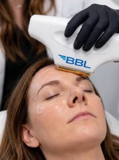 BBL handpiece during treatment